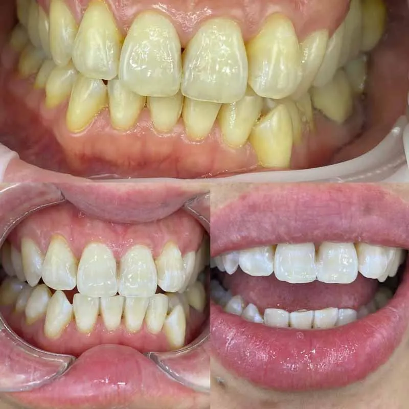 Best-Dentist-for-Teeth-Whitening-in-Melbourne-Dentist-Zoom-Whitening