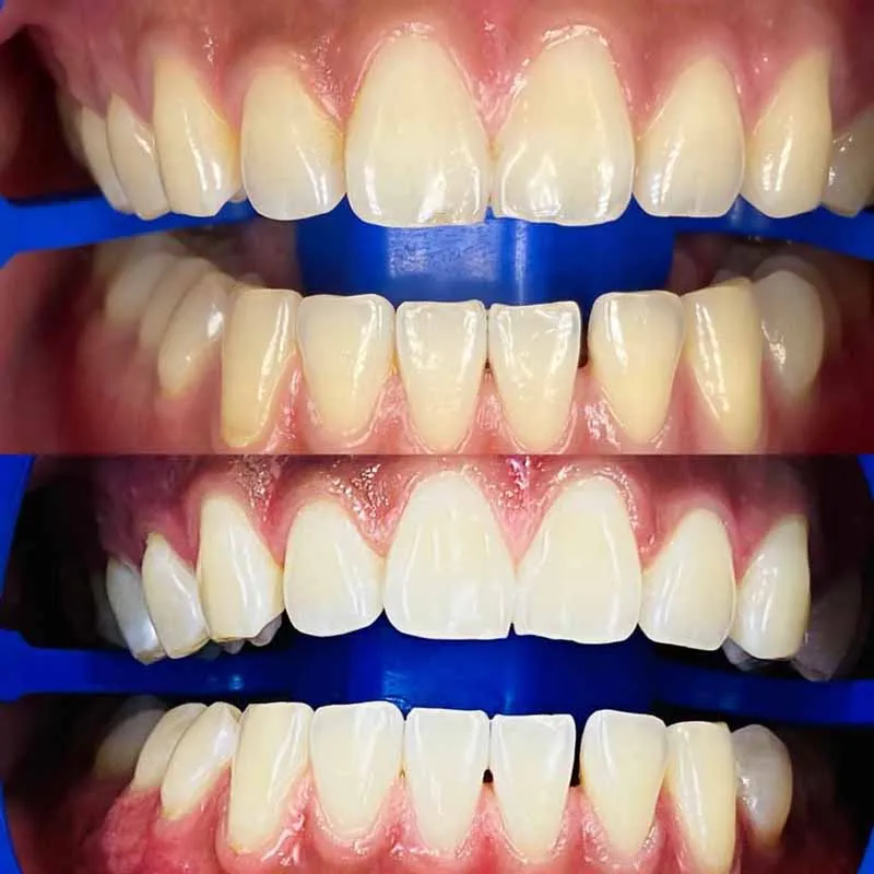 How-Good-is-Zoom-Whitening-Melbourne-Dentist