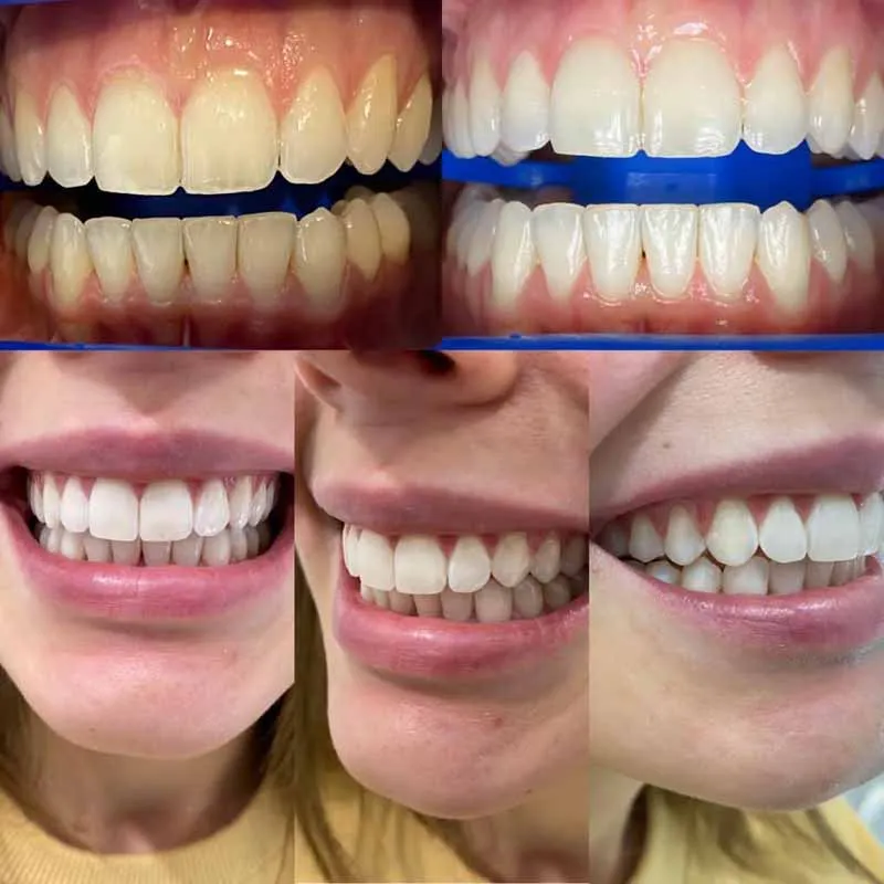 How-white-can-be-my-teeth-with-Zoom-Whitening-Blackburn-dentist