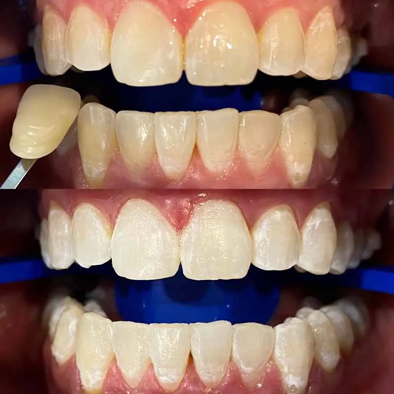 In-office-teeth-whitening-Melbourne-Dentist