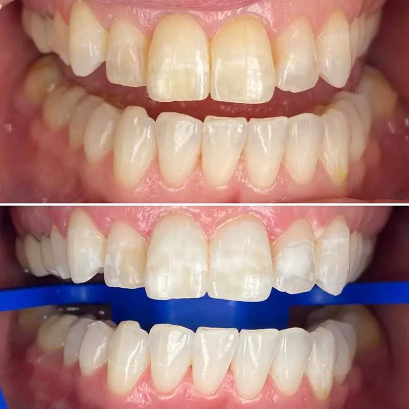 Is-zoom-whitening-the-best-for-whiter-teeth