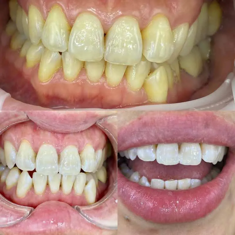 Melbourne-dentist-for-teeth-whitening