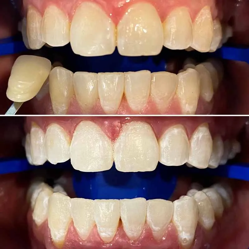Teeth-Whitening-Blackburn-Healthy-Smiles-Dental