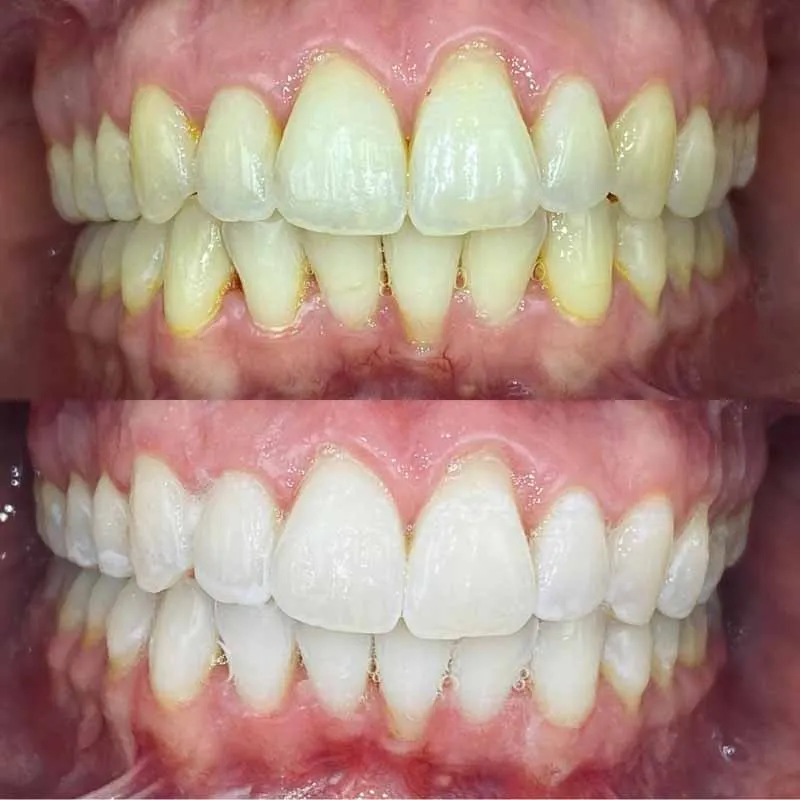 Teeth-Whitening-results-in-chair-treatment-Blackburn