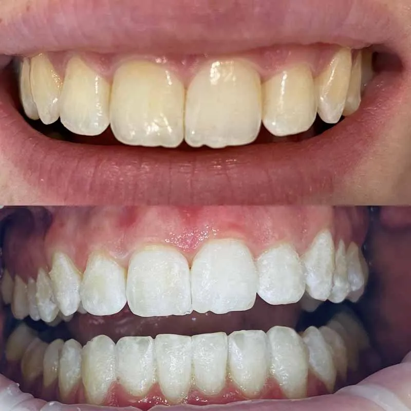 Zoom-Teeth-Whitening-Melbourne-Healthy-Smiles-Dental-Group