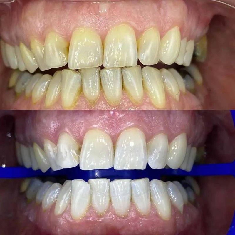 can-anyone-have-a-teeth-whitening-done-at-dentist