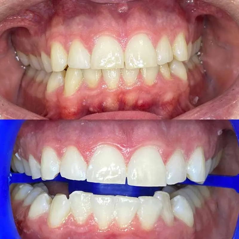how-can-I-whiten-my-teeth-without-breaking-the-bank