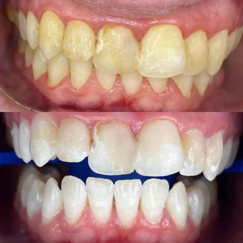 how-safe-is-zoom-teeth-whitening-in-Melbourne